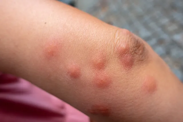close-up-pictures-of-bed-bug-bites-10