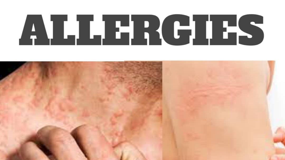 What is allergy?